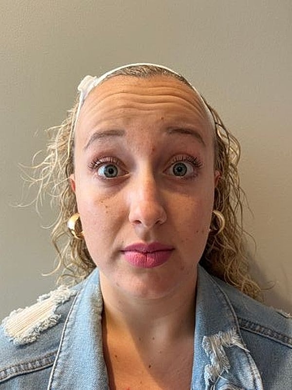 Botox Before & After