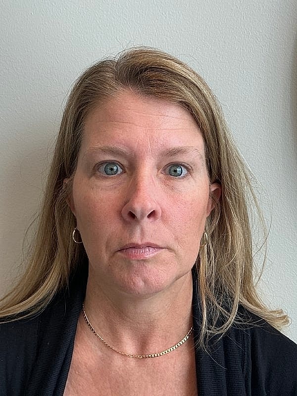 Botox Before & After