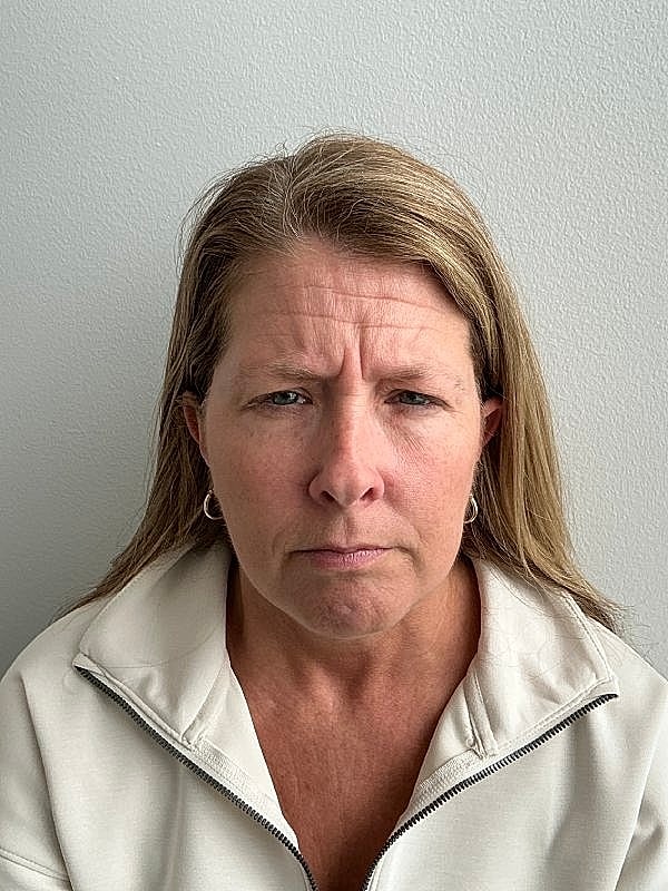 Botox Before & After