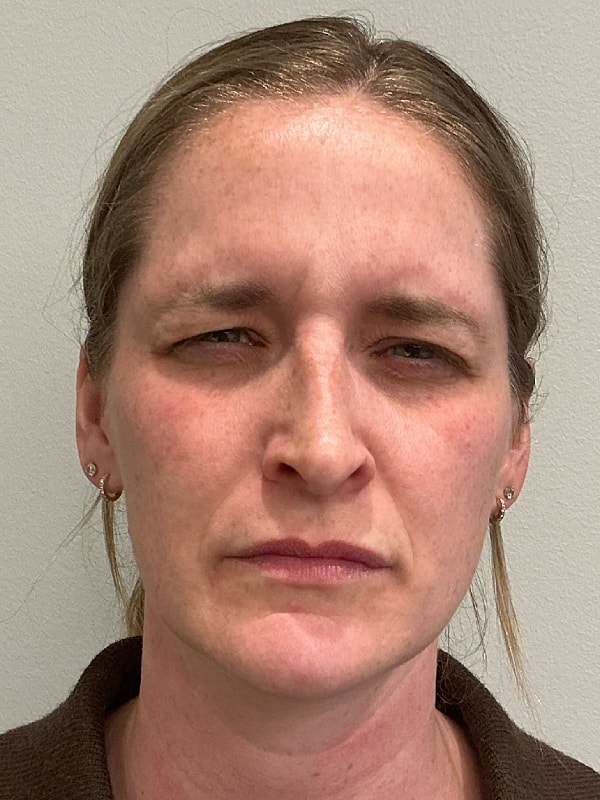 Botox Before & After