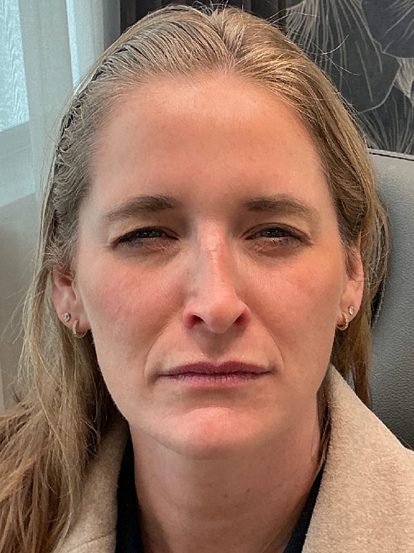 Botox Before & After