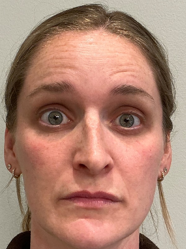 Botox Before & After