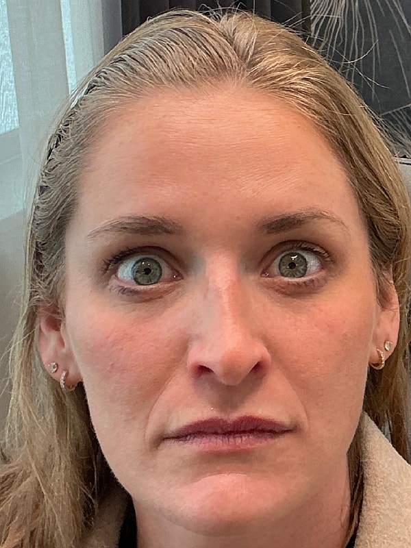 Botox Before & After