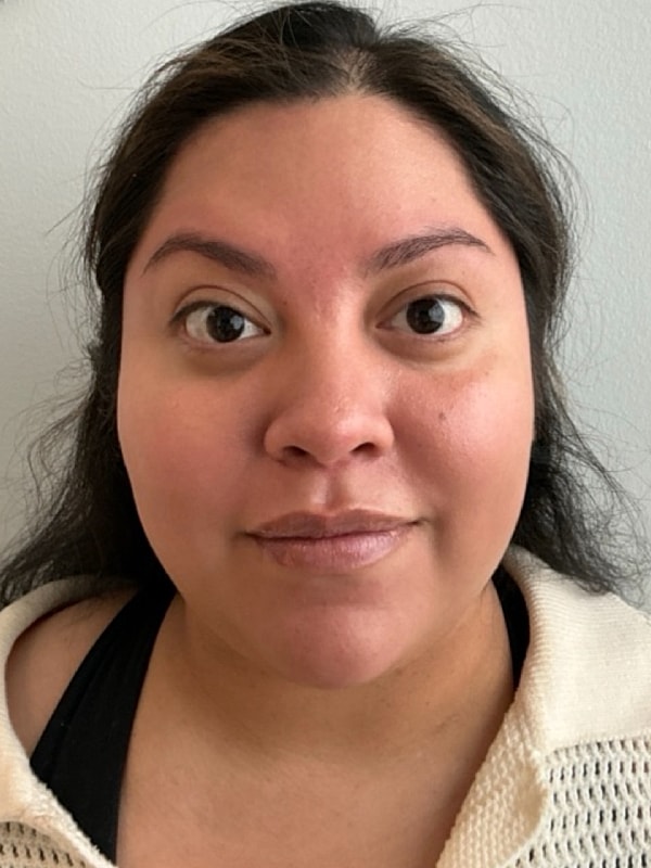 Botox Before & After