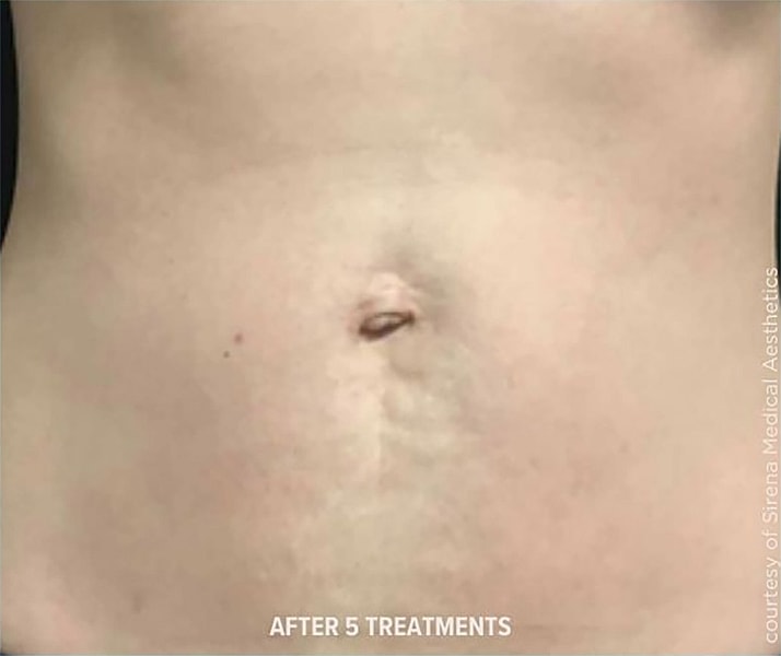 SkinTyte Before & After