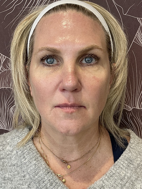 HydraFacial Before & After