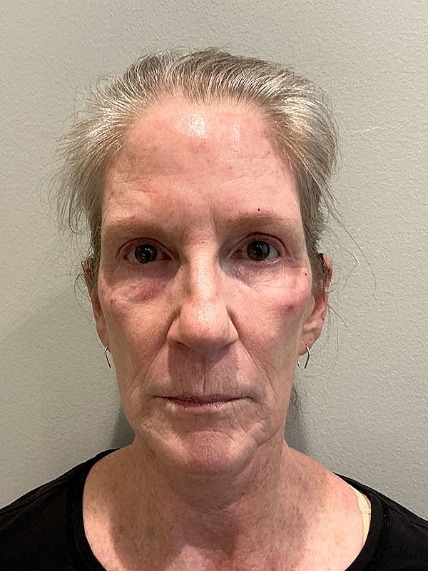 Marionette Lines Before & After