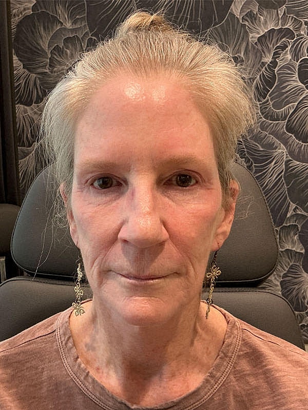 Marionette Lines Before & After