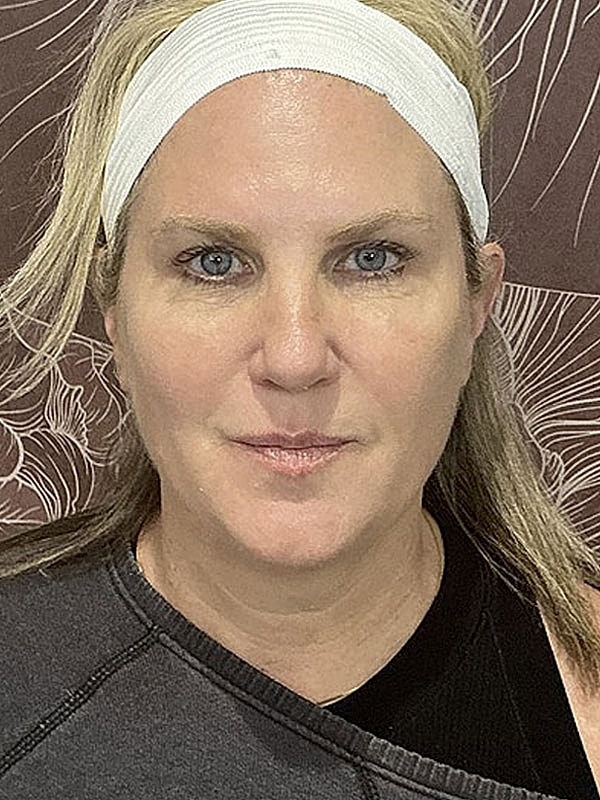 Microneedling Before & After