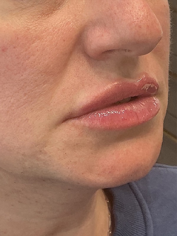 Lip Filler Before & After