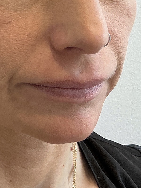 Lip Filler Before & After