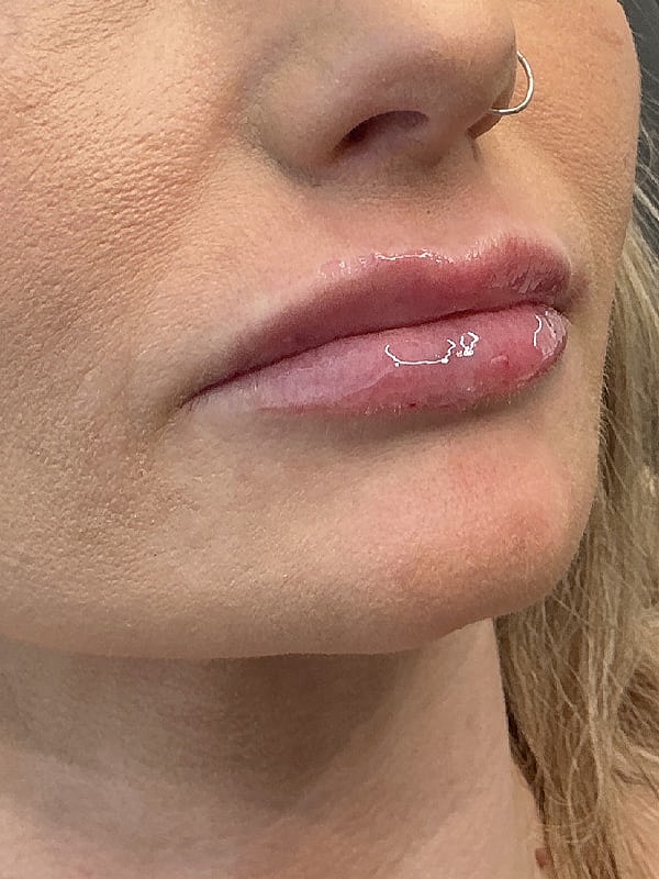 Lip Filler Before & After