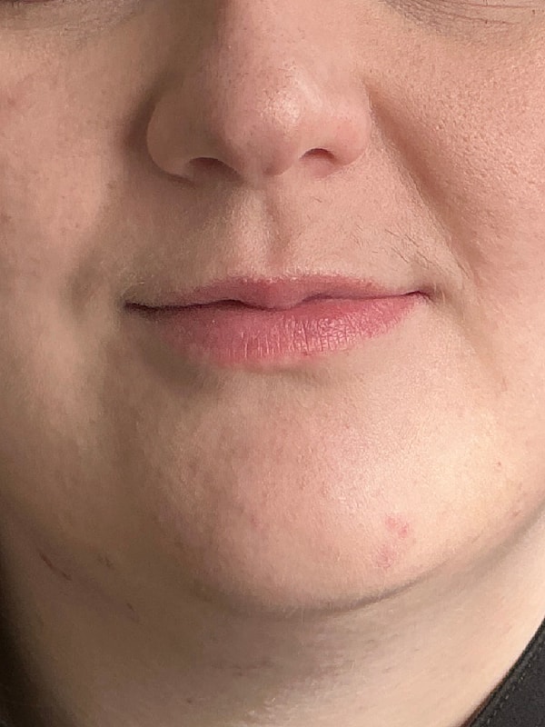 Lip Filler Before & After
