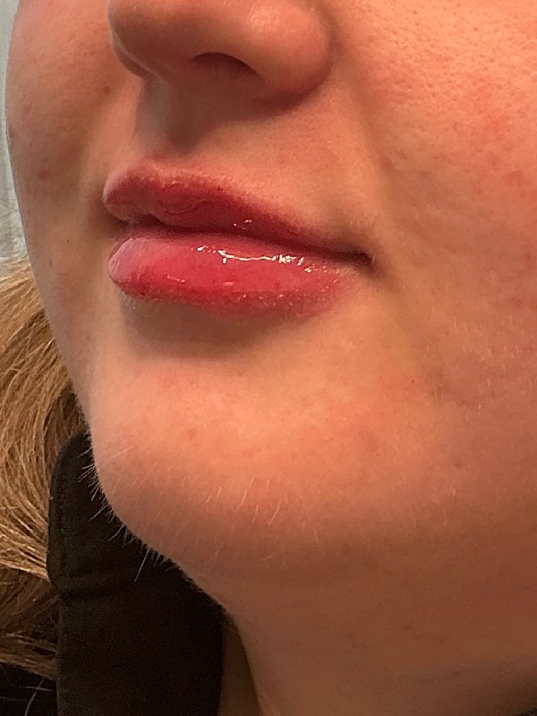 Lip Filler Before & After