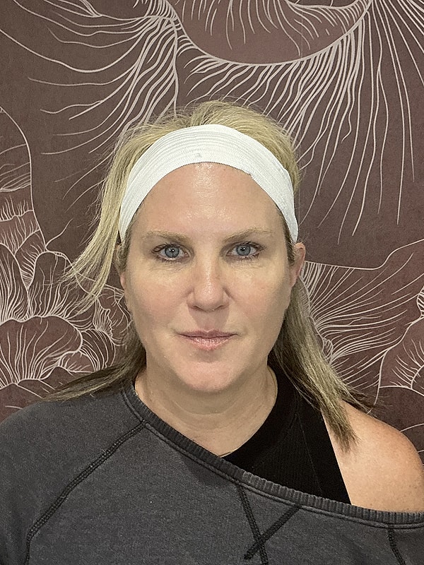 Full Facial Balancing Before & After