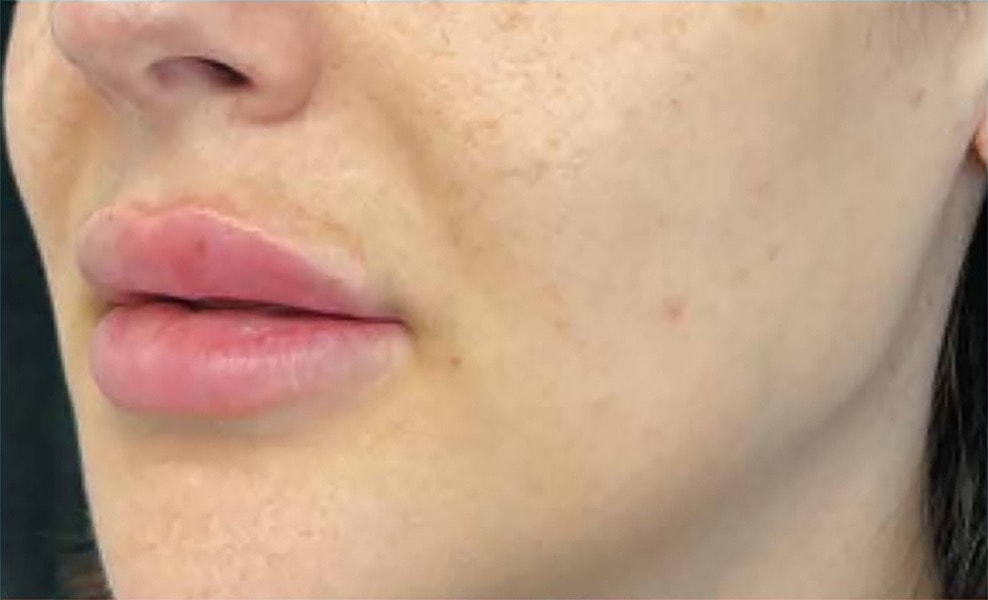 BBL Heroic Before & After