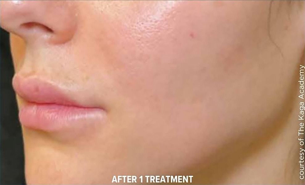 BBL Heroic Before & After