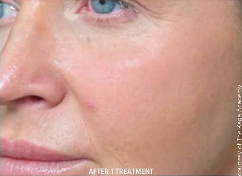 BBL Heroic Before & After