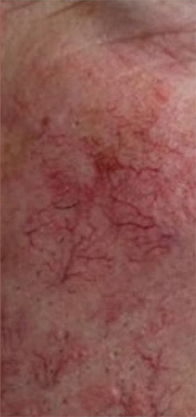 BBL Heroic Before & After