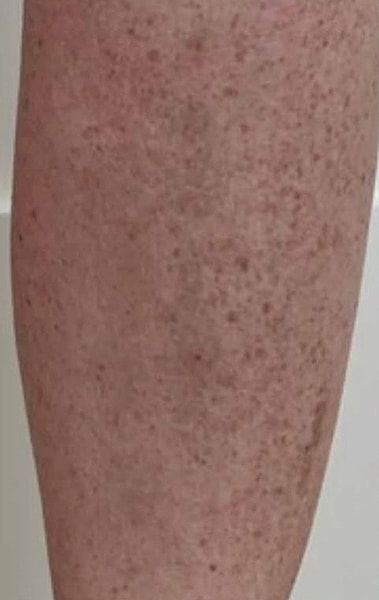 BBL Heroic Before & After