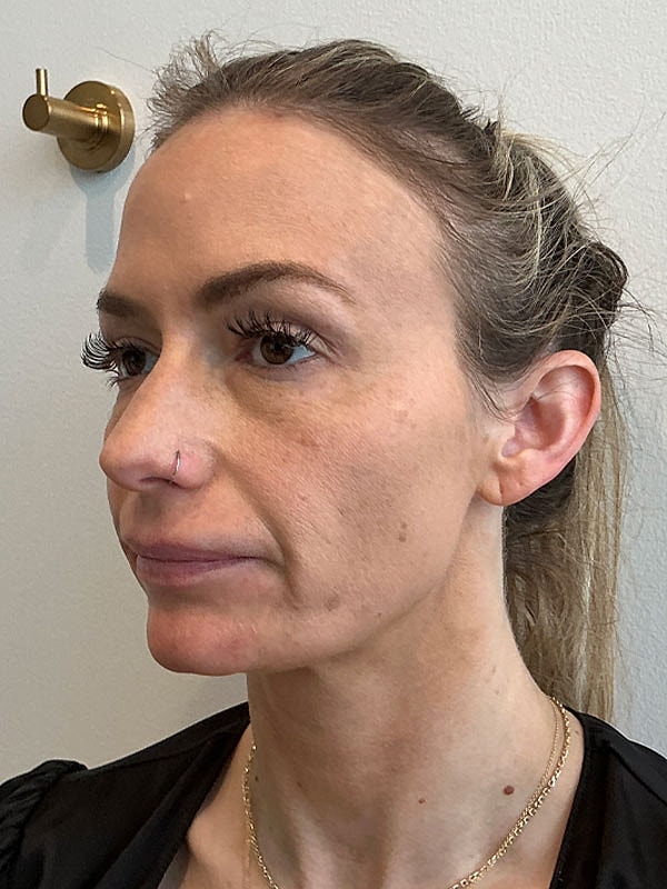 Sculptra Before & After